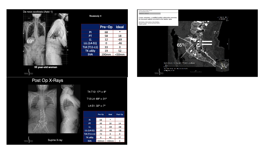 PSO - Posterior subtraction osteotomy