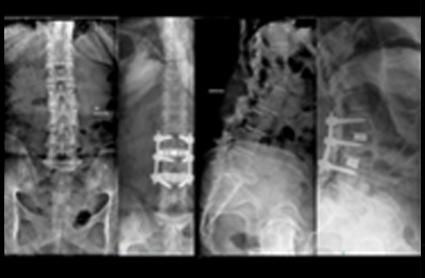 Prone XLIF - Minimally Invasive Spine Surgery