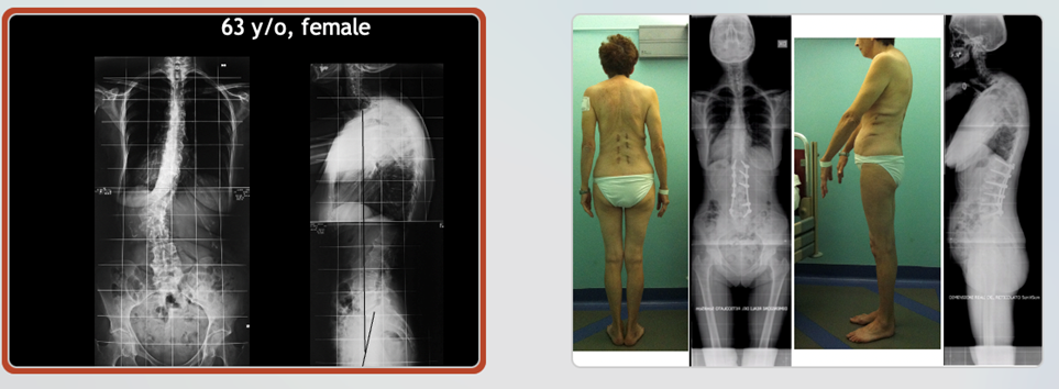 MISS - Minimally Invasive Spine Surgery